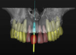 The corresponding scan can then be used to digitally plan the case with the implant in the ideal location for the proposed single-tooth restoration.