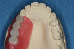 A full-contour wax-up/trial tooth setup is necessary in this case to re-establish normal anatomy for optimal pink and white esthetics.