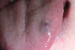 Patient presented with a 9-mm x 12-mm raised bluish-red lesion with regular-shaped borders.