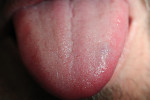 At the 1-month postoperative appointment, the lesion was visibly gone; no nodule or firmness was noted in the tongue where the lesion had been.