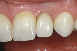 Figure 17  The final all-ceramic, single-implant restoration at cementation.