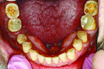 Fig 3. The mandibular arch showed minimal loss of enamel on the anterior teeth but previous damage on the posterior teeth.