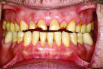 Fig 8. A view in MIP, after cementation of the lower crowns and onlays.