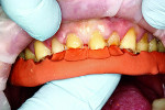 Fig 9. Putty splint in place to guide the direct
composite restorations for the maxillary anterior teeth.