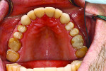 Fig 12. Lingual view of porcelain crowns cemented on maxillary anterior teeth.