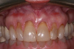 Fig 1. Pretreatment view showed gingival recession defects of teeth Nos. 7 through 10.