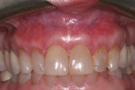 Fig 6. Reevaluation at 20 months showed the stability of the gingival contours and gingival margins.