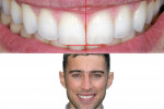 Fig 3. Facial landmarks determine the midline and a second interpupillary line aligns the horizontal plane of the central incisors.