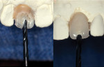 Figure 1  A 3/32-inch twist drill was used to create a pilot hole through the denture tooth on the cast.
