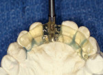 Figure 4  The completed surgical stent fabricated with Triad gel is carried over the incisal edge to create stability of the stent to the adjacent teeth.