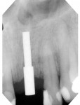 Figure 8  A radiograph of a guide pin in the initial osteotomy was taken to verify position and parallelism relative to the adjacent teeth.