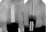 Figure 9  Radiographs of the implant placed using the surgical stent demonstrates final positioningrelative to the stent’s sleeve.