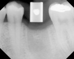 Figure 10  A radiograph showing an open Guide Right sleeve for placement of a lower first molar.