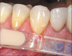 Figure 2  The Voco Amaris® composite shade guide was used to take a preoperative cervical shade of the patient’s teeth.