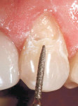 Figure 4  A slight bevel preparation was made on tooth No. 11.
