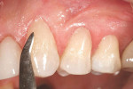Figure 7  The dentin/opaque composite material in 03 was placed using an esthetic contour placement instrument.