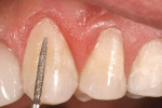 Figure 10  The surface texture of the restorations was refined using a diamond bur.