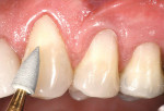 Figure 14  By applying light pressure, three components of an innovative polishing system were used to impart a final polish and luster to the restorations.