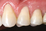 Figure 16  Postoperative view of the final restorative results that were achieved using the simplified esthetic composite system.