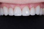 The adhesive’s low film thickness contributed to passively seating the indirect ceramic restorations.