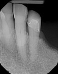 Radiograph shows margin integrity and fit of bonded restoration.