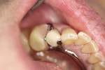 The final crown bonded in place, partial denture attached, showing accurate clasp engagement and partial fit.