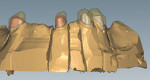 Fig 1 and Fig 2. Once a preliminary model is poured in Type IV resin reinforced gypsum, a digital scan is performed and the primary telescopic crowns are digitally designed.