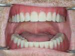 Fig 10. At the final delivery appointment, the clinician evaluates the digital dentures for fit, function, esthetic appearance, and patient acceptance.