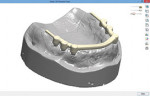 Fig 4. The bar is designed over the ridge with room for teeth set-up.