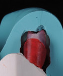 Fig 7 and Fig 8. Using the silicone index to check the available space for the esthetic parts.