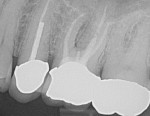 Fig 1. Preoperative radiograph demonstrating vertical root fracture of tooth No. 14.