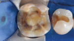 Fig 2. Clinical situation after the removal of the old restorations.