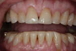 Posttreatment photographs showing the restoration of the occlusal defects caused by the abrasive and erosive wear.