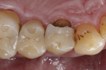 Fig 1. Fractured palatal cusp adjacent to a glass-ceramic inlay.
