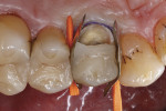 Fig 5. Placing metal matrix bands in the proximal areas to protect the neighboring teeth.