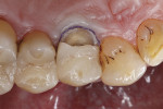 Fig 4. A retraction cord was placed in the gingival sulcus to control the soft tissues.