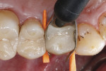 Fig 13. A regular-viscosity nanohybrid Ormocer was applied to reconstruct the lost palatal cusp of the premolar.