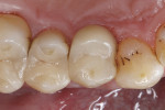 Fig 16. The finished repair restoration reconstructs the original tooth shape and function.