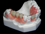 Figure 2 A full acrylic, rubberized, soft partial denture.