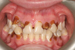 Case 2, pretreatment retracted occlusion (after debridement) to better assess the extent of the caries.
