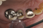 Figure 1  Preoperative view of failing restoration on tooth No. 5.