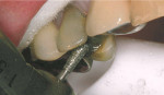 Figure 2  Performing occlusal reduction.