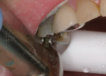 Figure 3  Contacts were broken with the adjacent teeth.