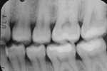 Figure 2  Pretreatment radiograph of tooth No. 13.