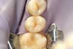 Figure 3  Tooth No. 13 was isolated with a rubber dam.