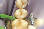 Figure 4  The distal aspect of tooth No. 13 was wedged.