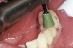 A medium (green) cup was used to polish the occlusal surface at a slow speed with water and light pressure.