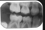 Figure 8  Bitewing radiograph of tooth S showing small caries lesions on the mesial and distal.