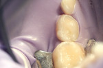 Figure 9  Tooth S was isolated with a rubber dam.