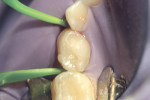 Figure 10  Tooth S was also wedged on both proximal aspects.